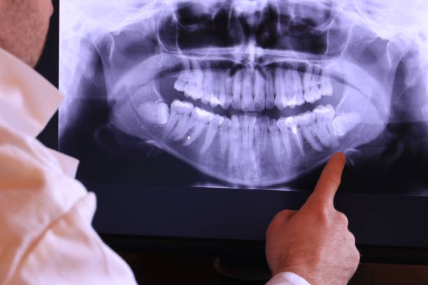 Best Emergency Dentist for Lost Fillings or Crowns in Appalachia, VA